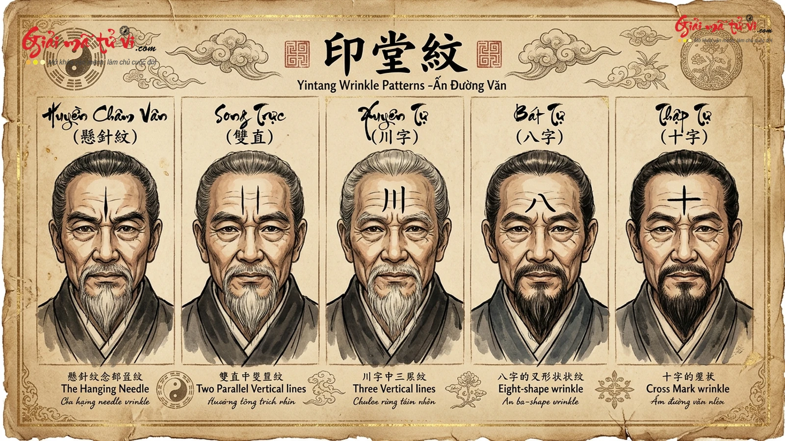Đồ hình huyệt vị Ấn Đường Mệnh Cung: Huyền Châm Văn, Song Châm Văn, Bát Tự Văn và Xuyên Tự Văn